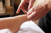 San Francisco Acupuncture
